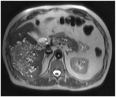 Case Report: Successful DaVinci-Assisted Major Liver Resection for Alveolar Echinococcosis